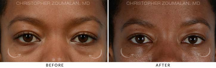 Lower Lid Blepharoplasty Before & After Photo - Patient Seeing Straight - Patient 1A