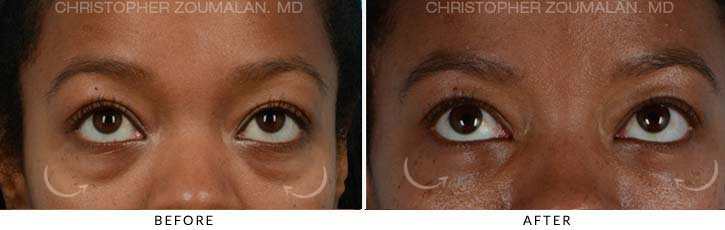 Lower Lid Blepharoplasty Before & After Photo - Patient Seeing Up - Patient 1B