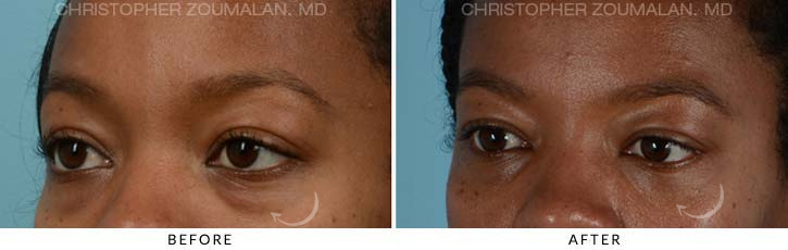 Lower Lid Blepharoplasty Before & After Photo - Patient Seeing side - Patient 11C