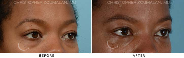 Lower Lid Blepharoplasty Before & After Photo - Patient Seeing side - Patient 6D
