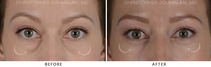 Lower Lid Blepharoplasty Before & After Photo - Patient Seeing Straight - Patient 12A