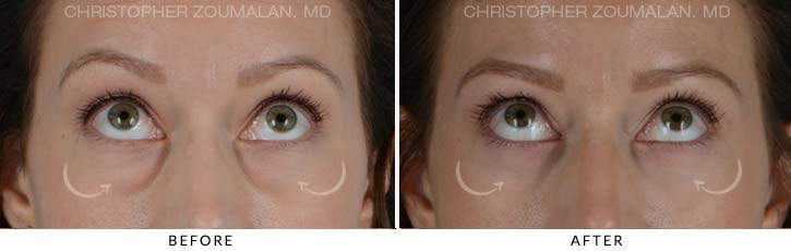 Lower Lid Blepharoplasty Before & After Photo - Patient Seeing Up - Patient 12B