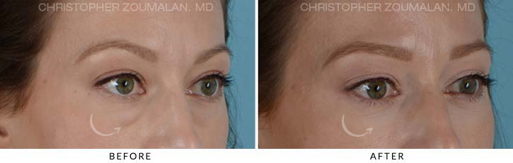 Lower Lid Blepharoplasty Before & After Photo - Patient Seeing Side - Patient 12C