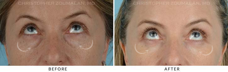 Lower Lid Blepharoplasty Before & After Photo - Patient Seeing Up - Patient 13B