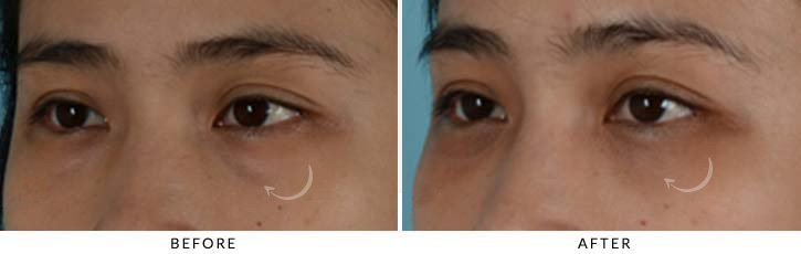 Lower Lid Blepharoplasty Before & After Photo - Patient Seeing Side - Patient 14C