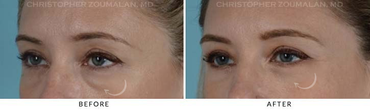 Lower Lid Blepharoplasty Before & After Photo - Patient Seeing Side - Patient 15D