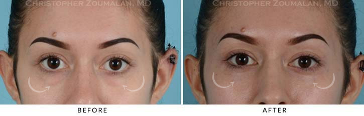 Lower Lid Blepharoplasty Before & After Photo - Patient Seeing Straight - Patient 16A