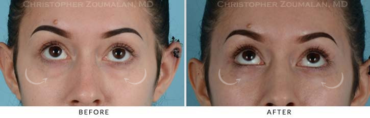 Lower Lid Blepharoplasty Before & After Photo - Patient Seeing Up - Patient 11B