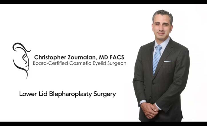 Lower Eyelid Blepharoplasty - Click to view the Video