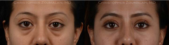 Lower lid blepharoplasty using Natural Looking Blepharoplasty Technique - female patient before and after picture