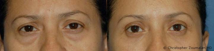 Upper and lower lid blepharoplasty, periorbital and lower lid fat grafting - female patient before and after picture