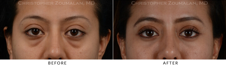 Lower Lid Blepharoplasty Before & After Photo - Patient Seeing Straight - Patient 19A