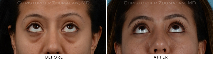 Lower Lid Blepharoplasty Before & After Photo - Patient Seeing Up - Patient 19B