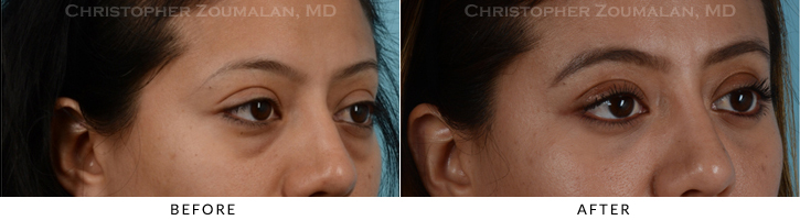 Lower Lid Blepharoplasty Before & After Photo -  - Patient 19C