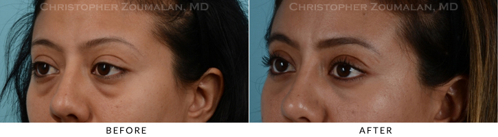 Lower Lid Blepharoplasty Before & After Photo - Patient Seeing Side - Patient 19D