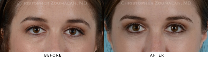 Lower Lid Blepharoplasty Before & After Photo - Patient Seeing Straight - Patient 20A