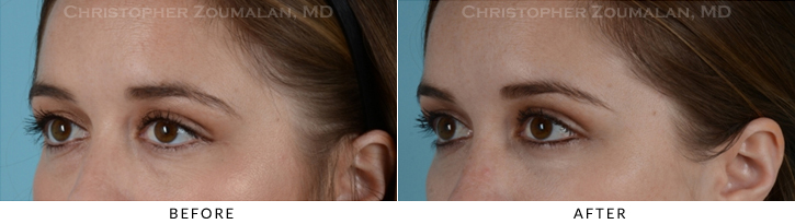 Lower Lid Blepharoplasty Before & After Photo - Patient Seeing Side - Patient 20B