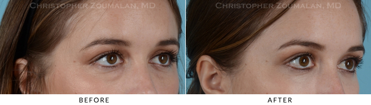 Lower Lid Blepharoplasty Before & After Photo -  - Patient 20C