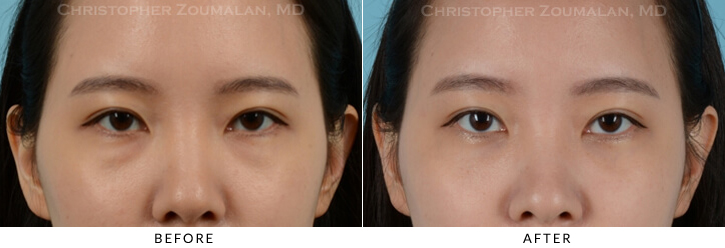 Lower Lid Blepharoplasty Before & After Photo - Patient Seeing Straight - Patient 21A