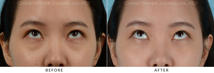 Lower Lid Blepharoplasty Before & After Photo - Patient Seeing Up - Patient 21B