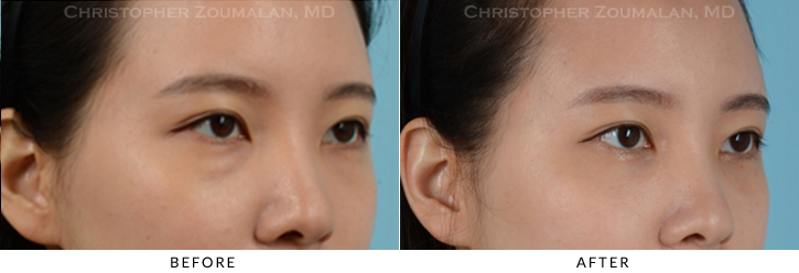 Lower Lid Blepharoplasty Before & After Photo -  - Patient 21C