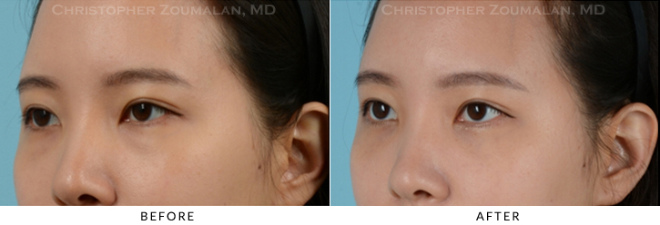 Lower Lid Blepharoplasty Before & After Photo - Patient Seeing Up - Patient 21D