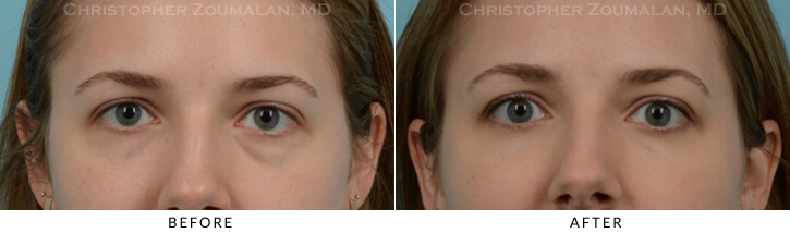 Lower Lid Blepharoplasty Before & After Photo - Patient Seeing Straight - Patient 22A