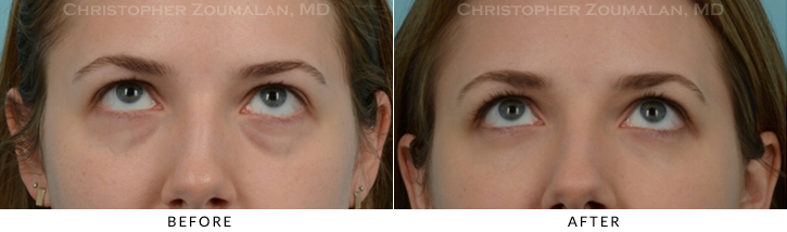 Lower Lid Blepharoplasty Before & After Photo - Patient Seeing Up - Patient 22B