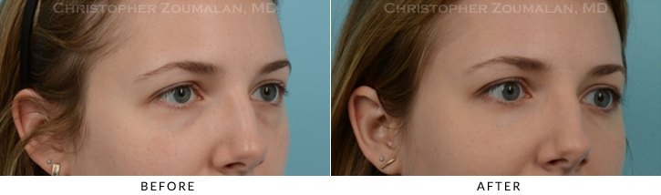 Lower Lid Blepharoplasty Before & After Photo -  - Patient 22C