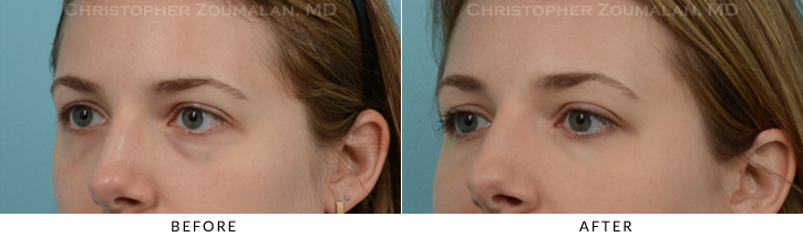 Lower Lid Blepharoplasty Before & After Photo - Patient Seeing Side - Patient 22D