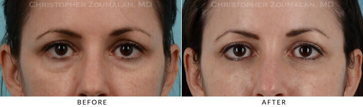 Lower Lid Blepharoplasty Before & After Photo - Patient Seeing Straight - Patient 23A