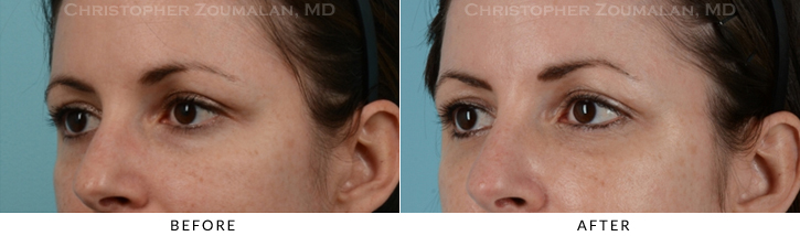 Lower Lid Blepharoplasty Before & After Photo - Patient Seeing Side - Patient 23D