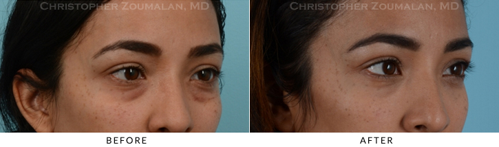 Lower Lid Blepharoplasty Before & After Photo -  - Patient 24C