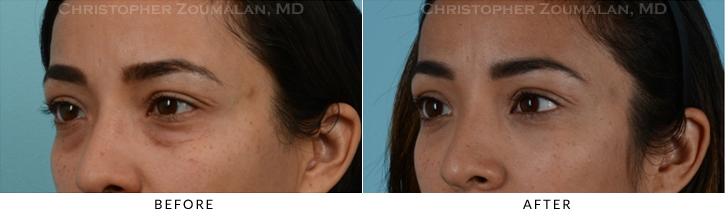 Lower Lid Blepharoplasty Before & After Photo - Patient Seeing Side - Patient 24D