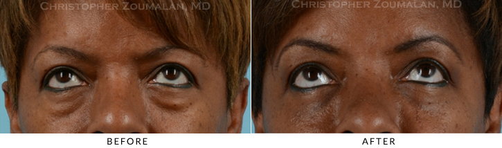 Lower Lid Blepharoplasty Before & After Photo - Patient Seeing Up - Patient 25B