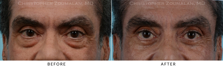 Lower Lid Blepharoplasty Before & After Photo - Patient Seeing Straight - Patient 26A