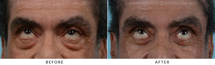 Lower Lid Blepharoplasty Before & After Photo - Patient Seeing Up - Patient 26B