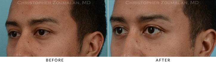 Lower Lid Blepharoplasty Before & After Photo - Patient Seeing Side - Patient 27D