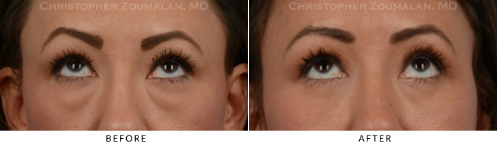 Lower Lid Blepharoplasty Before & After Photo - Patient Seeing Up - Patient 28B