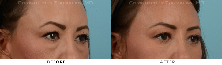 Lower Lid Blepharoplasty Before & After Photo -  - Patient 28C