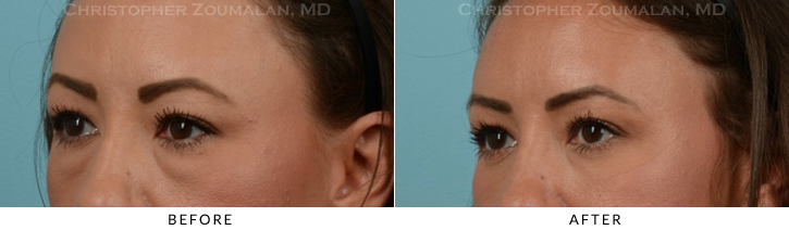 Lower Lid Blepharoplasty Before & After Photo - Patient Seeing Side - Patient 28D
