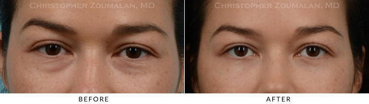 Lower Lid Blepharoplasty Before & After Photo -  - Patient 29