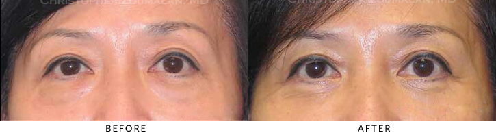 Lower Lid Blepharoplasty Before & After Photo - Patient Seeing Straight - Patient 32A