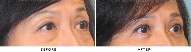 Lower Lid Blepharoplasty Before & After Photo - Patient Seeing Side - Patient 32B