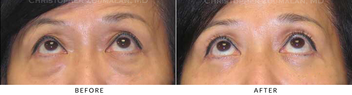Lower Lid Blepharoplasty Before & After Photo - Patient Seeing Up - Patient 32C