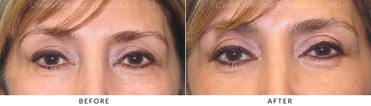 Lower Lid Blepharoplasty Before & After Photo - Patient Seeing Straight - Patient 33A