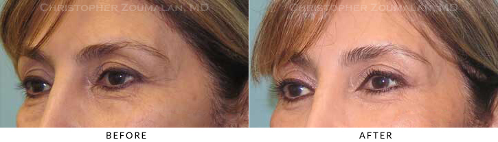 Lower Lid Blepharoplasty Before & After Photo - Patient Seeing Side - Patient 33B