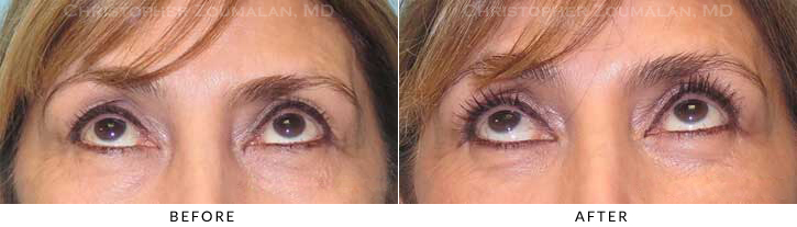 Lower Lid Blepharoplasty Before & After Photo - Patient Seeing Up - Patient 33C