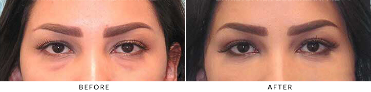 Lower Lid Blepharoplasty Before & After Photo - Patient Seeing Straight - Patient 34A