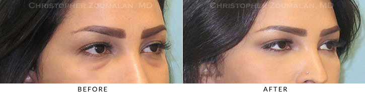 Lower Lid Blepharoplasty Before & After Photo - Patient Seeing Side - Patient 34B